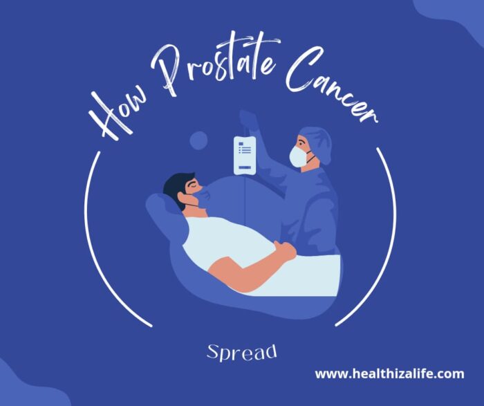 How Prostate Cancer Spreads Healthiza Life 5474