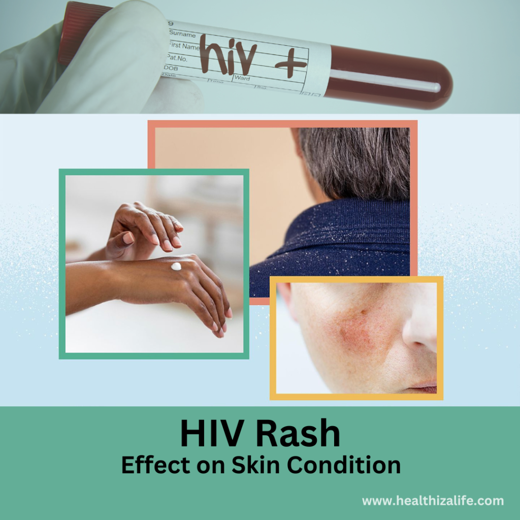 What is HIV Rash ? Symptoms & Treatments - Healthizalife