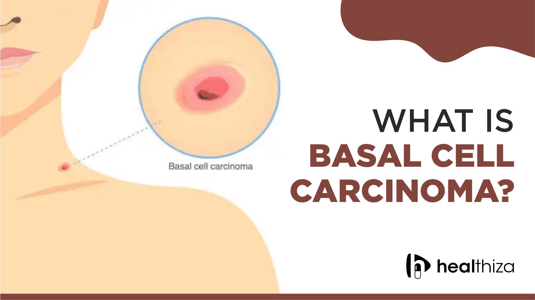 Basal Cell Carcinoma